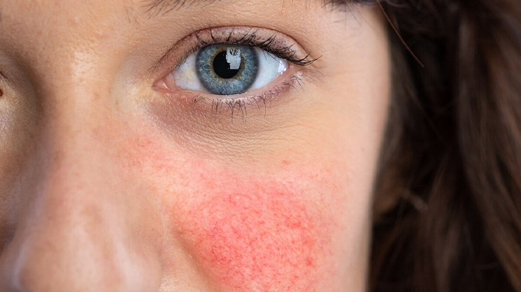 Yüzünüzdeki Kızarıklık Sadece Bir Utangaçlık mı?